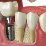 How to Take Care of Your Dental Implants