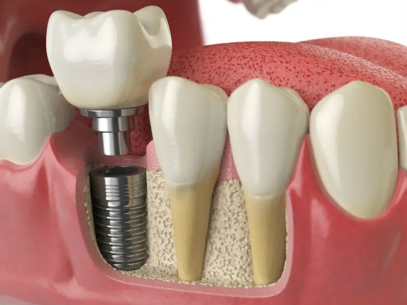 How to Take Care of Your Dental Implants